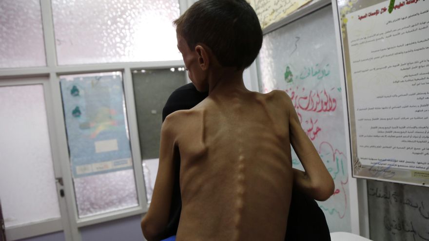 Niño desnutrido en un hospital de Saná, en Yemen.