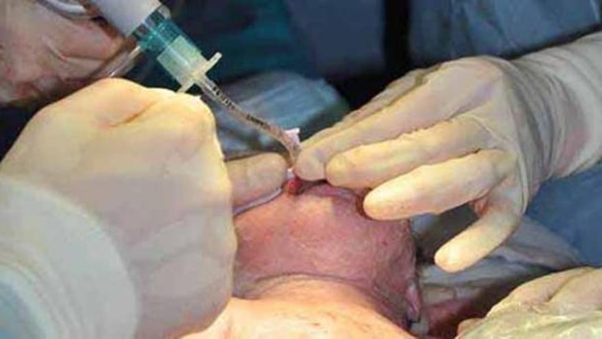 Operación de un niño en el momento del parto.