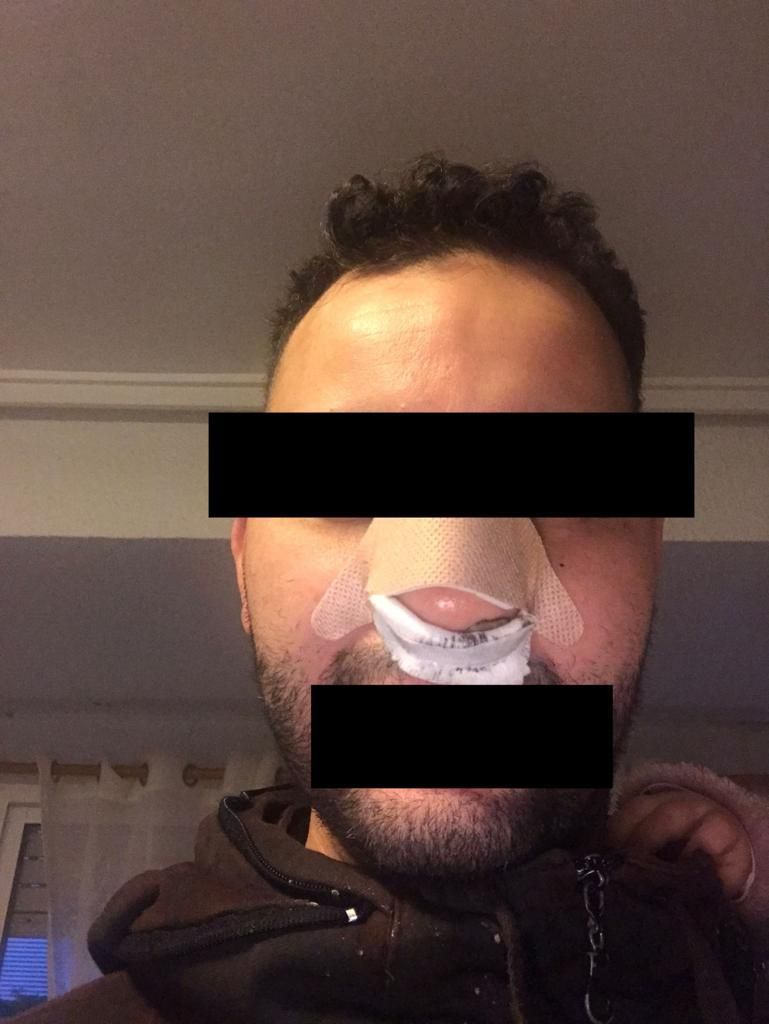 Rostro de la persona agredida fuera de la discoteca