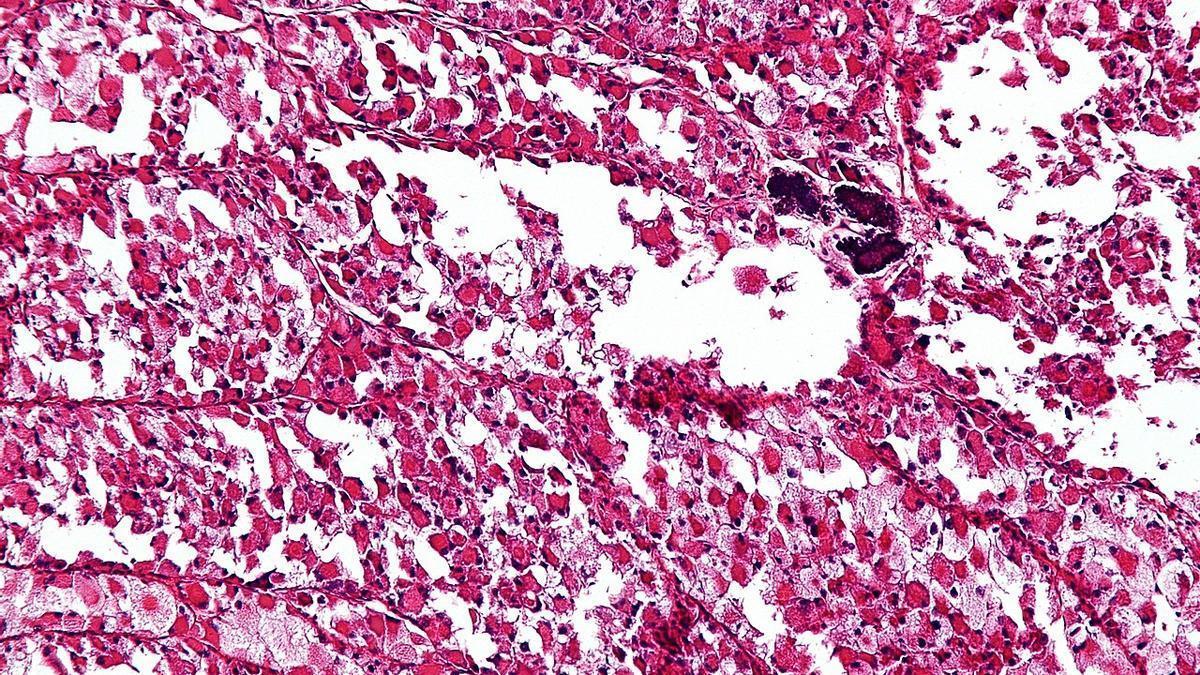 Sarcoma: así se detecta un cáncer poco frecuente, silencioso y que puede acabar en amputación de extremidad