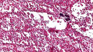 Micrografía ampliada de un sarcoma.