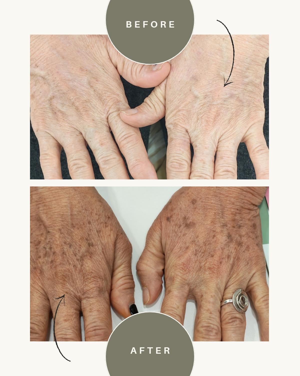 Ejemplo de fotorejuvenecimiento de manos con IPL.