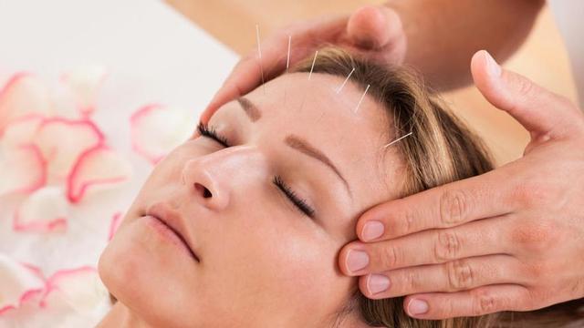 En China es habitual el uso de la acupuntura para tratar la migraña.