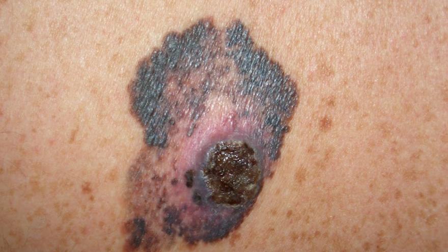 Aragón diagnostica entre 180 y 190 nuevos casos de melanoma al año