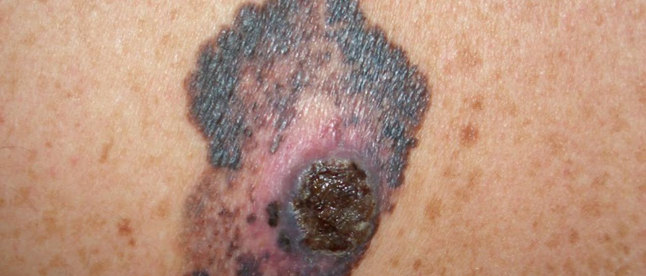 Un melanoma extirpado en el hospital Clínico.