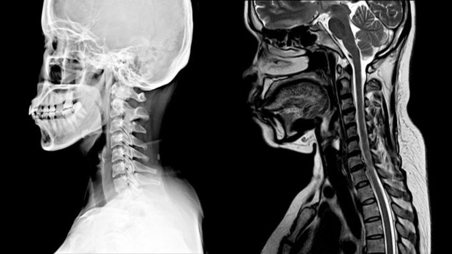 Día Mundial de la Esclerosis Múltiple: la primera causa de discapacidad entre los jóvenes de 20 a 40 años