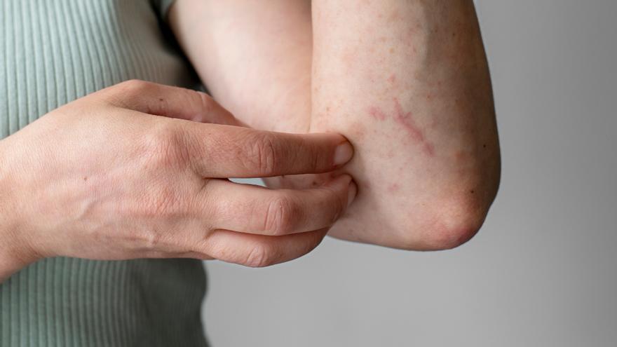 ¿Por qué te pica todo el cuerpo cuando hace frío? Así es la enfermedad que empeora en el invierno