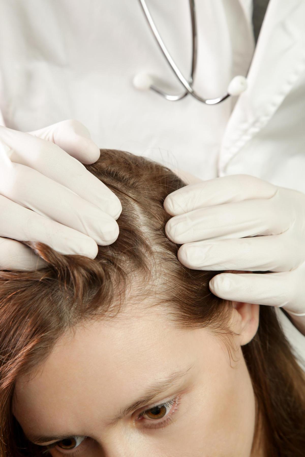 Los expertos avisan de la caída del pelo por tomar Ozempic
