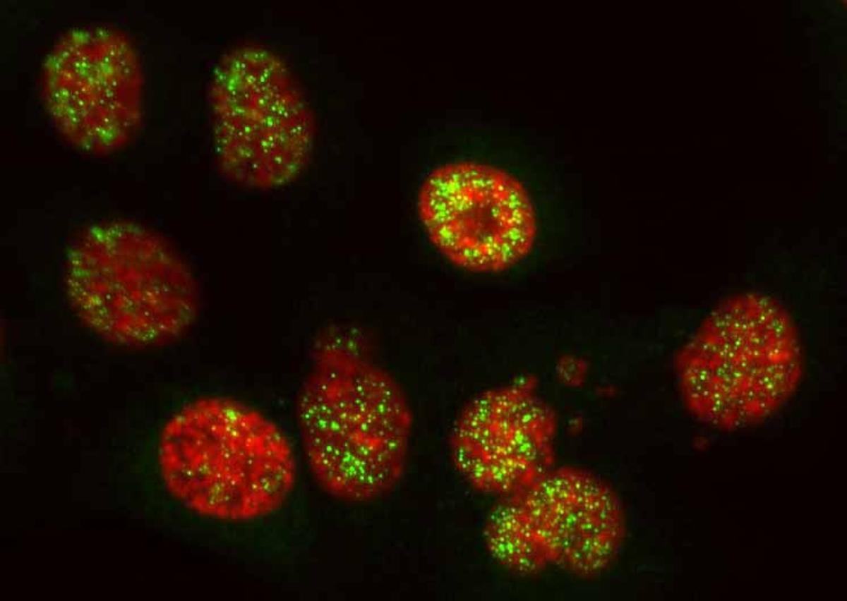Células de cáncer de páncreas donde se visualiza el ADN (rojo) y cGAS (verde), un sensor del sistema inmunitario