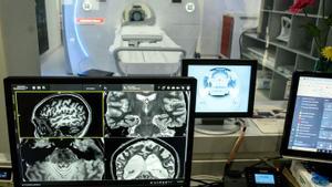 Un estudi vincula la demència amb els microplàstics al cervell