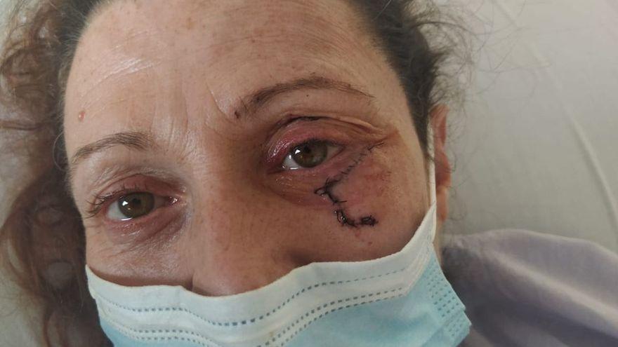 La víctima en el Hospital de Elda donde fue operada del ojo y sometida a observación por los daños craneales sufridos.