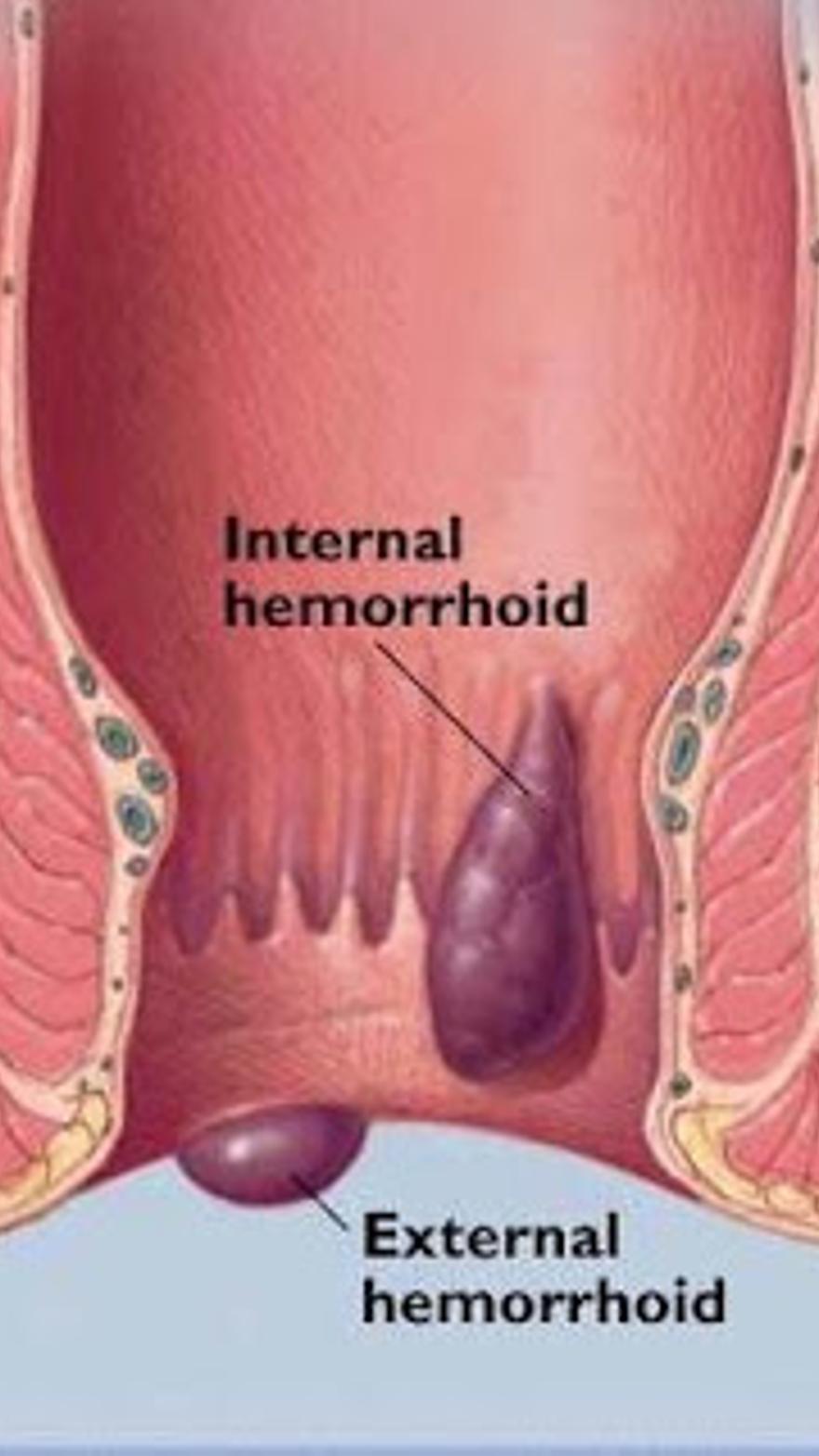 Hemorroides – Mitos y preguntas frecuentes - Información