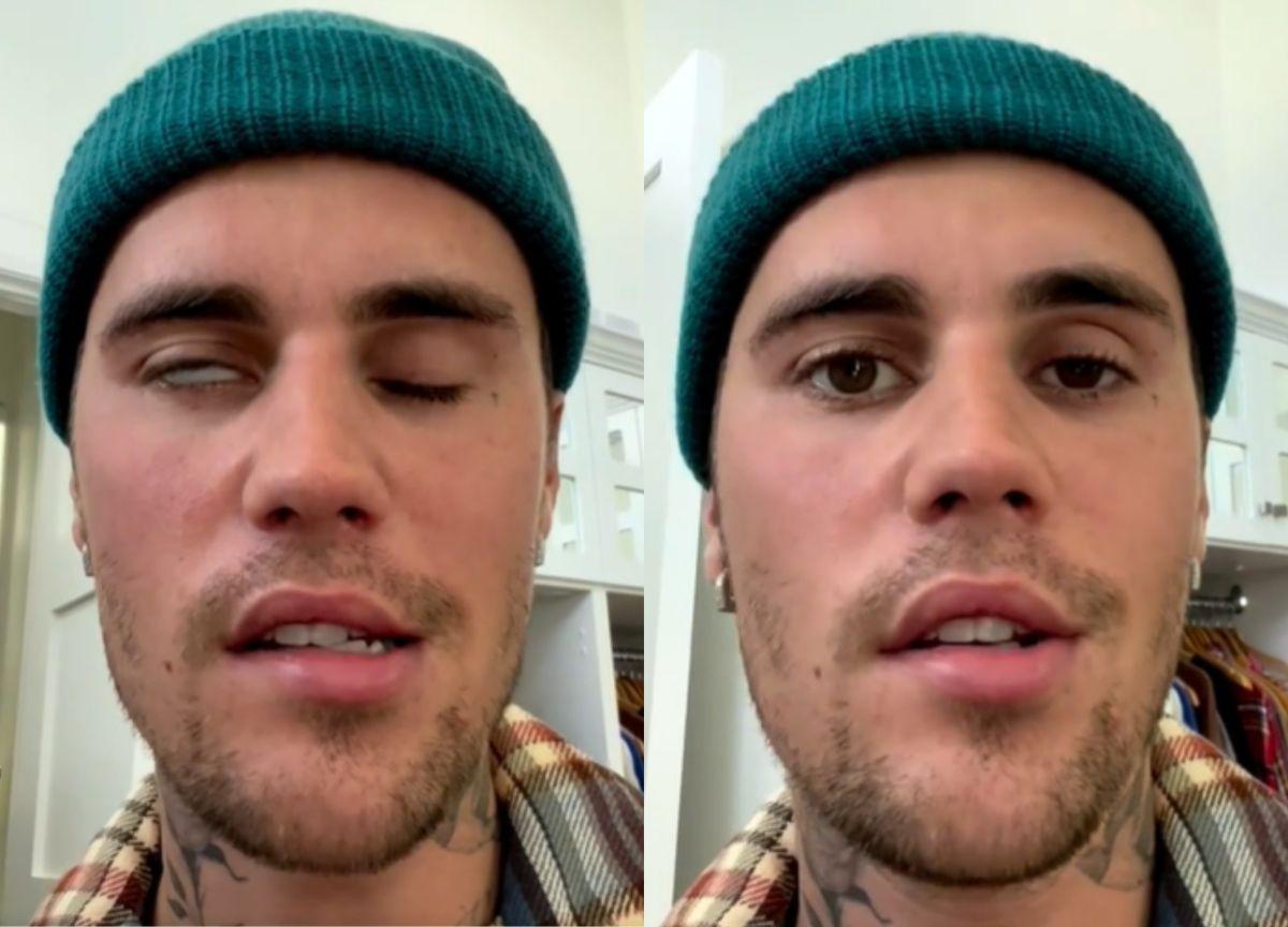 Síndrome de Ramsay Hunt: Así es la enfermedad que ha paralizado la cara de Justin Bieber