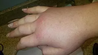 Lo que muchos ignoran sobre la inflamación: el Nobel que descubrió su lado bueno y su mayor riesgo