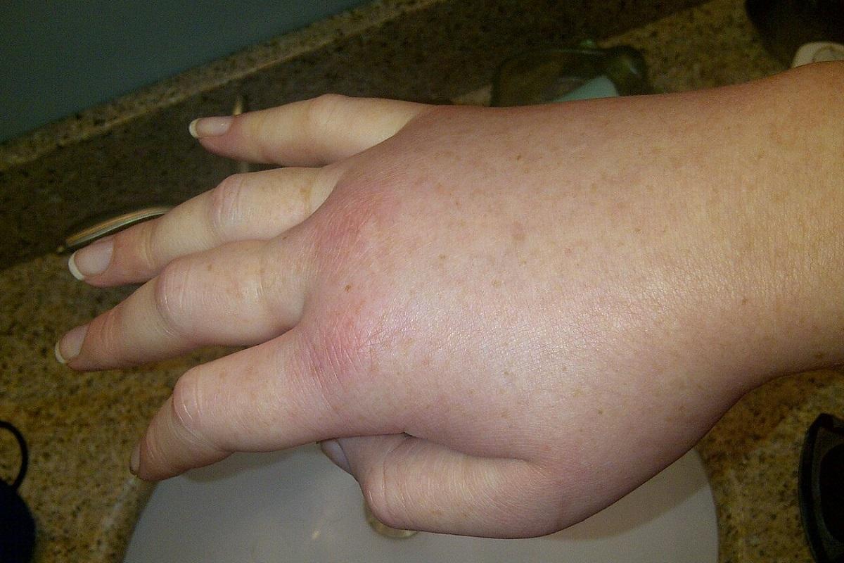 La inflamación que produce el angioedema no produce picor.