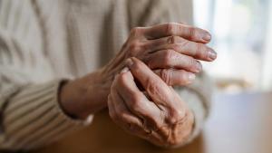 Manos de una persona con artritis reumatoide.