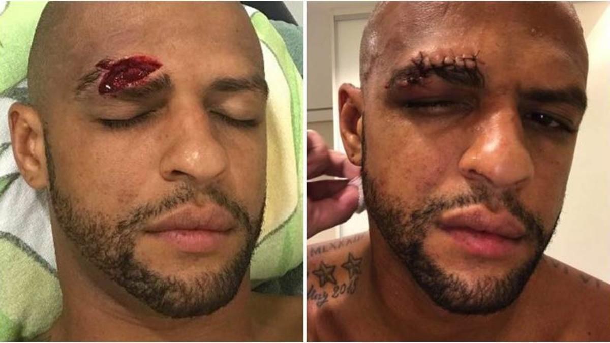 Felipe Melo mostró en las redes sociales cómo le quedó el rostro