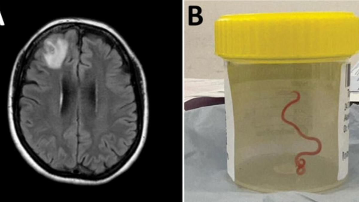 LOMBRIZ VIVA CEREBRO | Encuentran un gusano vivo, de más de 8 centímentros, en el cerebro de una mujer
