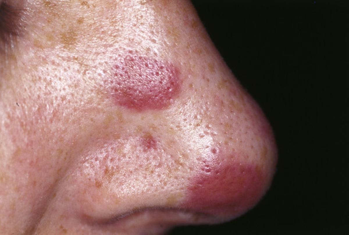 Sarcoma de Kaposi, con las placas violáceas características