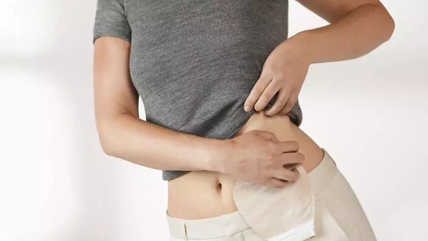 La sexualidad, una de las principales preocupaciones de las personas ostomizadas