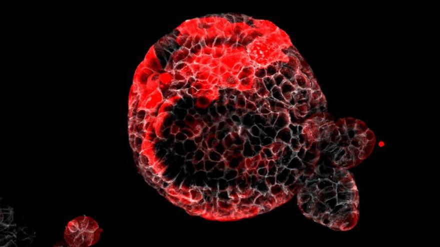 Organoide de càncer colorectal amb cèl·lules residuals responsables de la recaiguda marcades en vermell