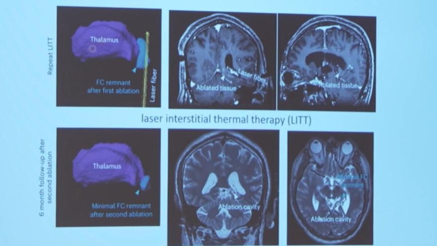 La mitad de las encefalopatías epilépticas del desarrollo no son diagnosticadas correctamente