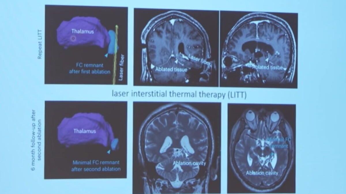 La mitad de las encefalopatías epilépticas del desarrollo no son diagnosticadas correctamente