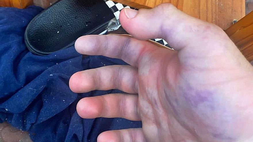 El joven ha perdido dos dedos por la picadura de una araña en Ibiza | DI