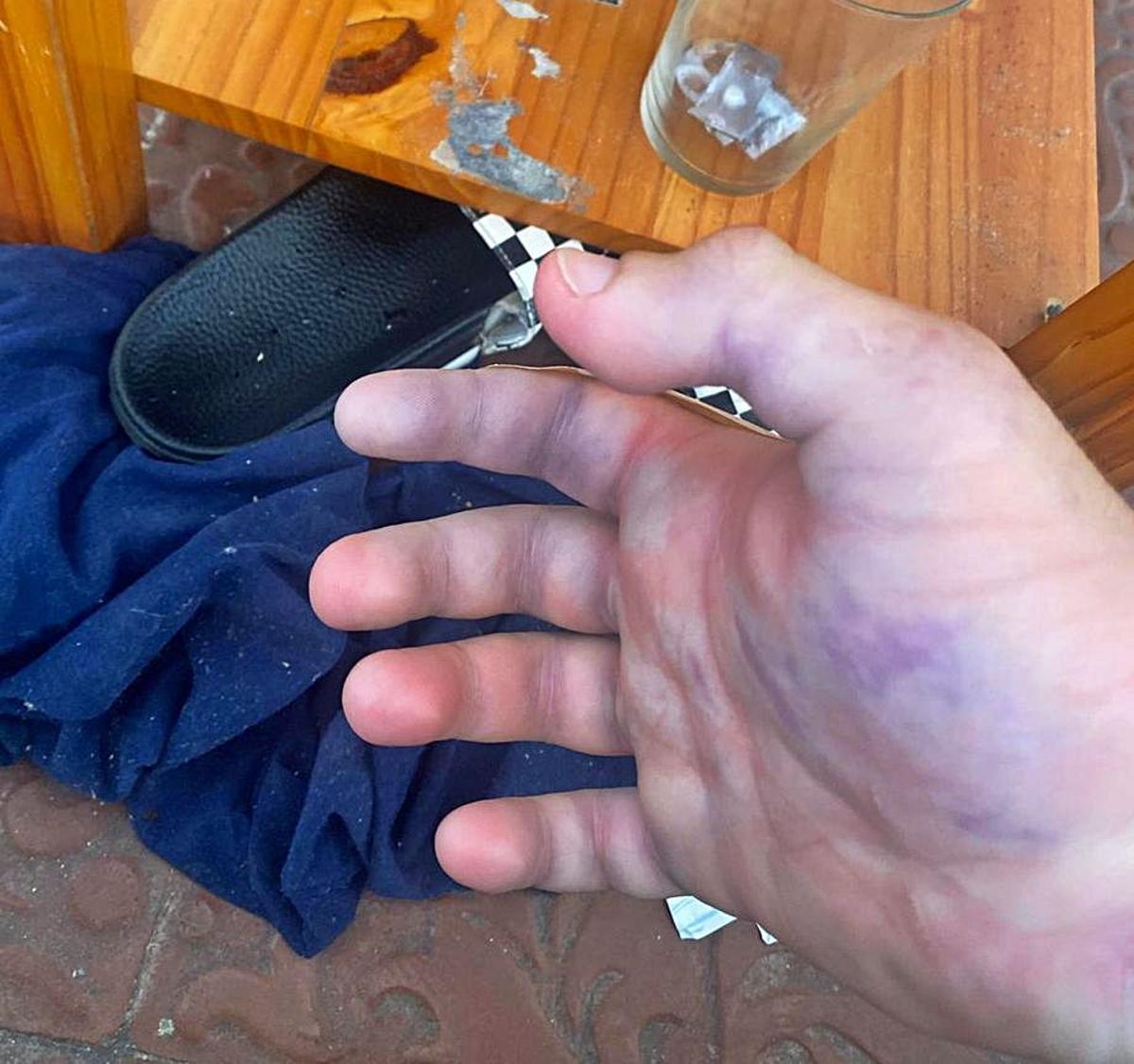 La misma mano al cabo de varias horas. | DI