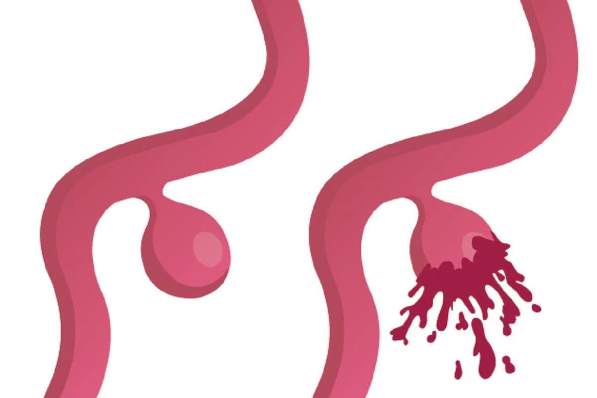 El aneurisma de aorta abdominal representan el 80% de todos los tipos de aneurismas.