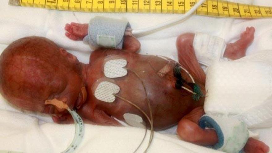 El bebé, el varón más pequeño del mundo al nacer, ha sobrevivido.