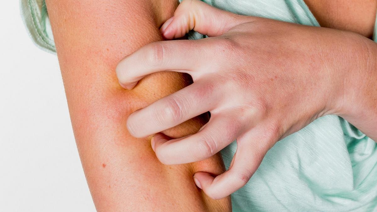 Los casos de dermatitis atópica se han triplicado en los últimos treinta años.