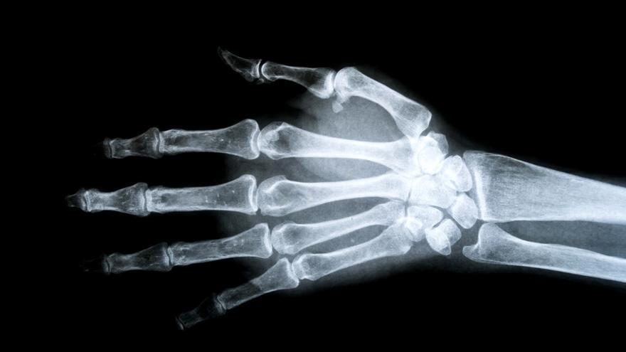Muñeca abierta o rotura del ligamento escafolunar: qué es, síntomas, tratamiento y cuál es el pronóstico