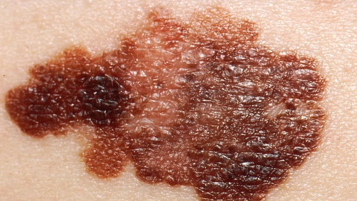 Una imagen que muestra en detalle de melanoma.