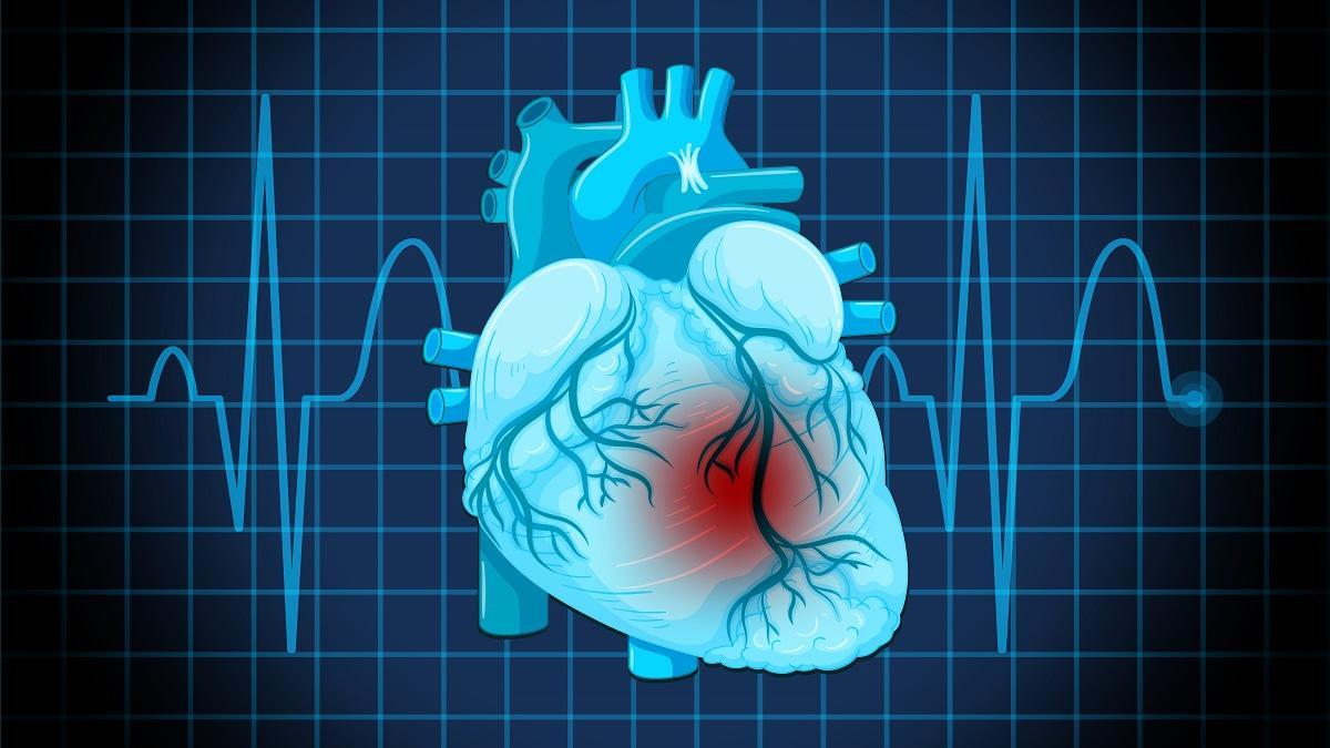 La insuficiencia cardiaca se produce porque el corazón no es capaz de bombear suficiente sangre.