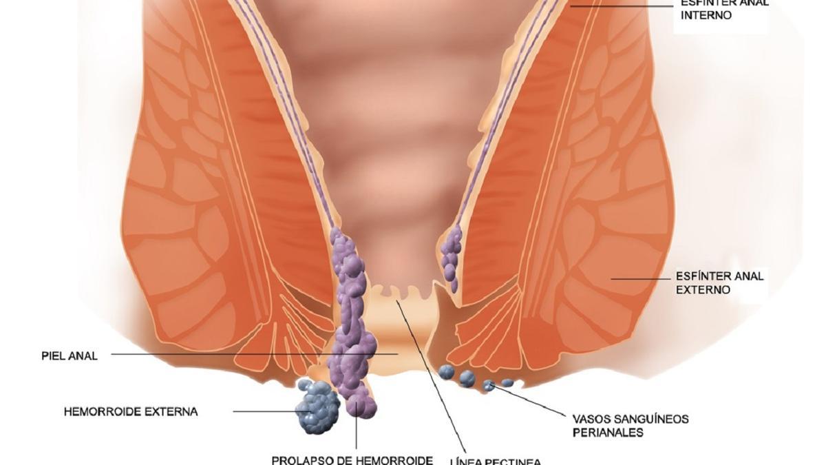 El lugar donde se produzca la inflamación va determinar del tipo de hemorroides.