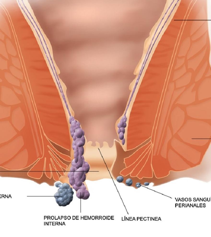 Cáncer de ano: el tumor que puede confundirse con hemorroides y afecta a mayores de 50 años
