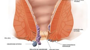 El lugar donde se produzca la inflamación va determinar del tipo de hemorroides.