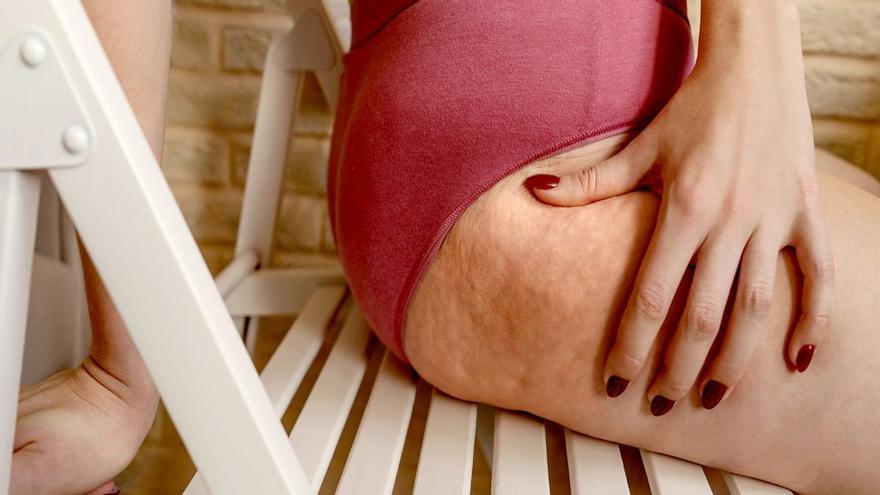 Què és el lipedema, la nova malaltia que afecta el 20% de les dones?