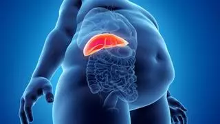 El 80% de jóvenes con sobrepaso padecen hígado graso, enfermedad que puede producir cirrosis o cáncer
