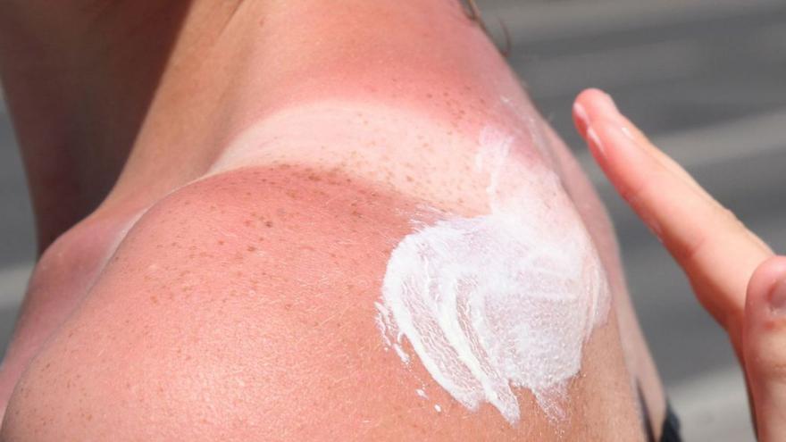 Was hilft bei Sonnenbrand? Tipps von Hautärzten auf Mallorca