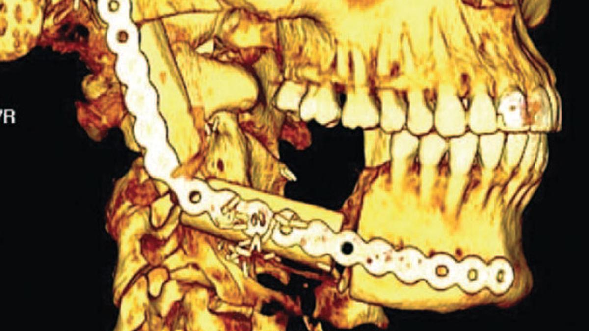 Es la primera vez que se combinan la técnica 3D y la cirugía poco invasiva para extraer un tumor grande y para la posterior reconstrucción mandibula