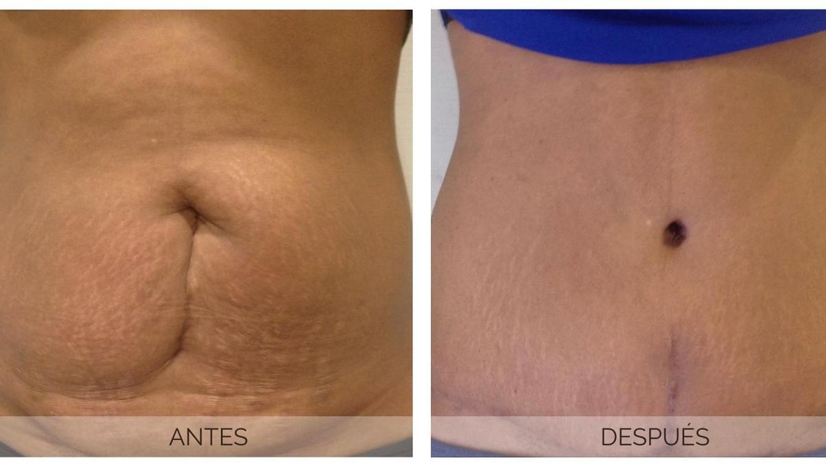 Antes y después de una cirugía corporal abdominoplastía del Dr. Antonio Mónaco.