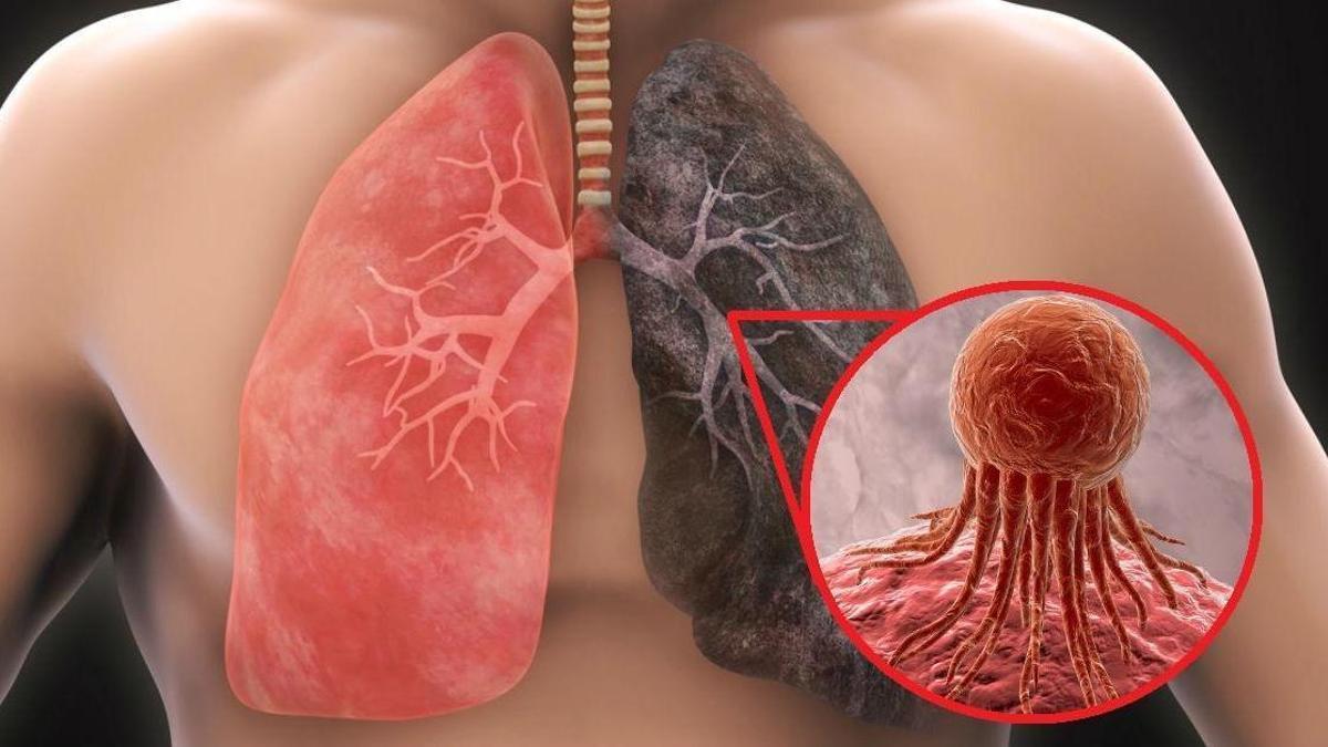 El de pulmón, es el tercer tumor más frecuente.