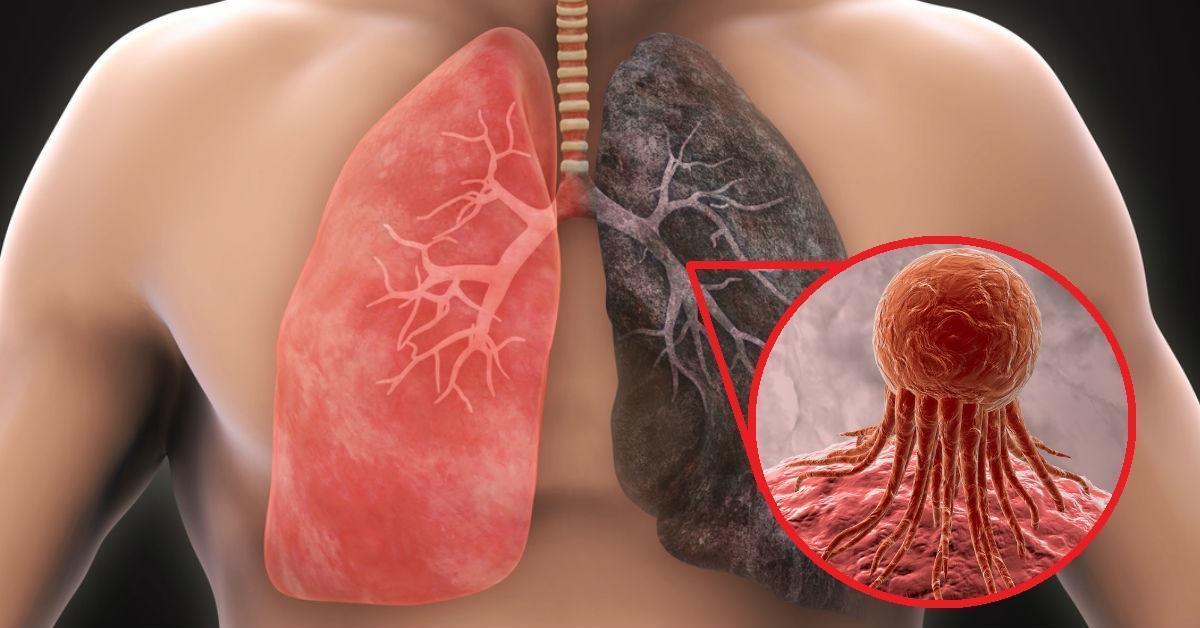 El de pulmón, es el tercer tumor más frecuente.