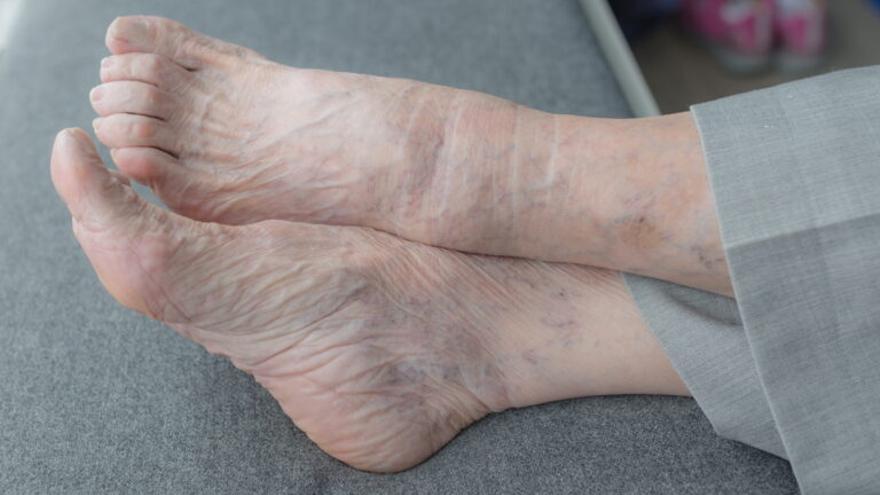 ¿Qué son y cómo se previenen las úlceras en las piernas, que afectan al 3% de los mayores de 60?
