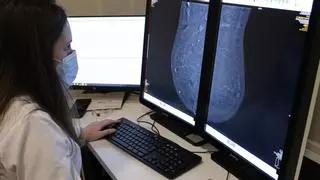 Cáncer de mama: el sistema puede ahorrar 5,9 millones al año con diagnósticos más tempranos