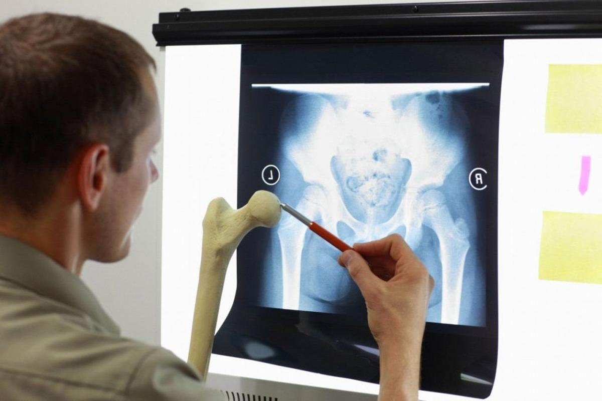 Es posible que el fémur se rompa debido a una osteoporosis severa