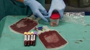 Una muestra de sangre de la que se extraen células madre. 