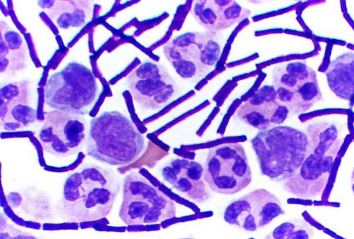 Líquido cefalorraquídeo tque muestra bacilos grampositivos del ántrax (bastones de color púrpura)